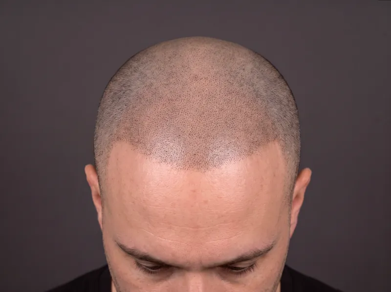 After scalp micropigmentation: restored hairline with even follicle density