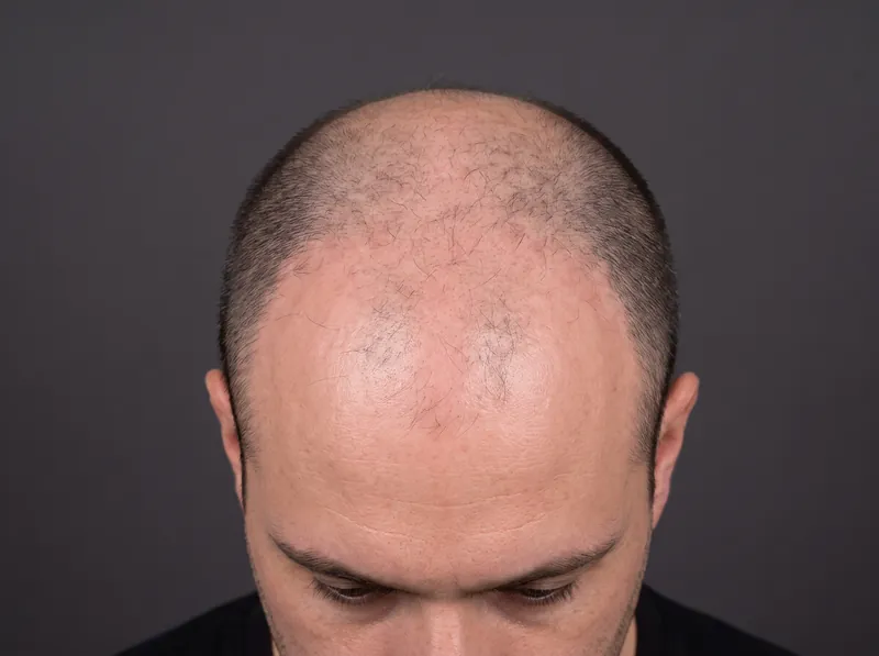 Before scalp micropigmentation: receded hairline and thinning crown