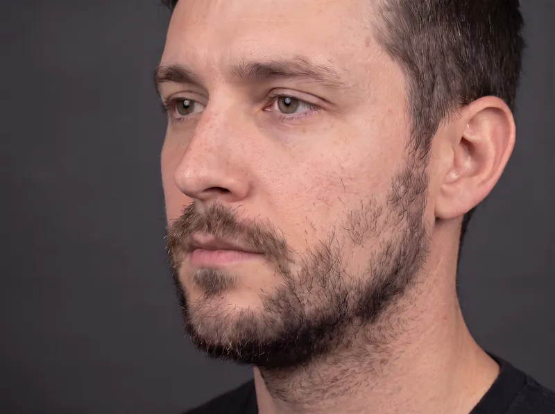 Before beard SMP: patchy beard growth