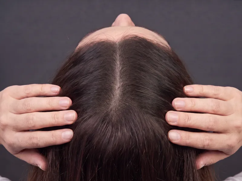 After women's density SMP: narrowed part line with fuller appearance